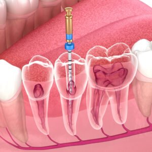 Quickdiagno Dental Root canal