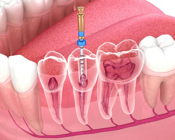 Quickdiagno Dental Root canal